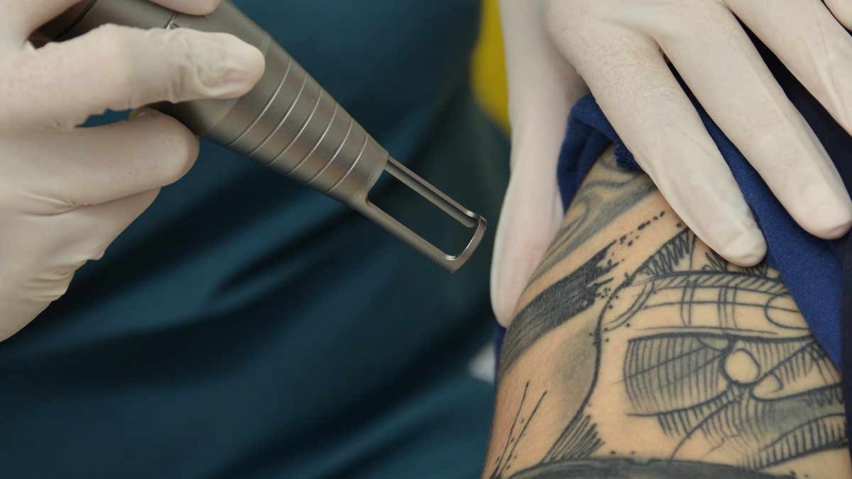 Todo lo que necesitas saber sobre la eliminación de tatuajes